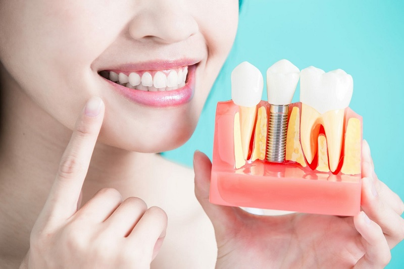 Dental implants: What Are the Benefits and Drawbacks? -